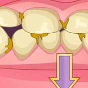 Schlechte Zähne Verjüngungskur
